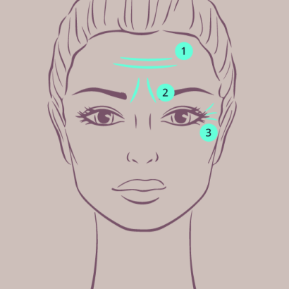 Eine Skizze für eine Botox-Behandlung beinhaltet die Darstellung der zu behandelnden Bereiche im Gesicht, Stirnfalten, Zornesfalten und Krähenfüße
